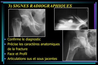 3) SIGNES RADIOGRAPHIQUES
• Confirme le diagnostic
• Précise les caractères anatomiques
de la fracture
• Face et Profil
• Articulations sus et sous jacentes
 