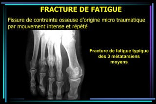 Fracture de fatigue typique
des 3 métatarsiens
moyens
FRACTURE DE FATIGUE
Fissure de contrainte osseuse d’origine micro traumatique
par mouvement intense et répété
 
