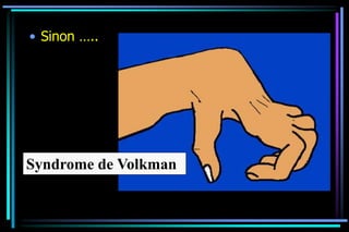 • Sinon …..
Syndrome de Volkman
 