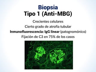Biopsia
Tipo 1 (Anti-MBG)
Crecientes celulares
Cierto grado de atrofia tubular
Inmunofluorescencia: IgG linear (patognomónico)
Fijación de C3 en 75% de los casos
 