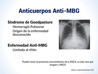 Anticuerpos Anti-MBG
Síndrome de Goodpasture
Hemorragia Pulmonar
Origen de la enfermedad
desconocido
Enfermedad Anti-MBG
Limitada al riñón
Pueden tener la presencia concomitantes de p-ANCA, es más raro que
tengan c-ANCA
 