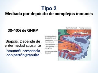 Tipo 2
Mediada por depósito de complejos inmunes
30-40% de GNRP
Biopsia: Depende de
enfermedad causante
Inmunofluorescencia
con patrón granular
 