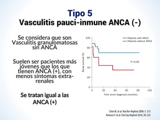 Tipo 5
Vasculitis pauci-inmune ANCA (-)
Se considera que son
Vasculitis granulomatosas
sin ANCA
Suelen ser pacientes más
jóvenes que los que
tienen ANCA (+), con
menos síntomas extra-
renales
Se tratan igual a las
ANCA (+)
 