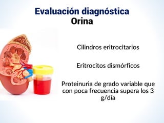 Evaluación diagnóstica
Orina
Cilindros eritrocitarios
Eritrocitos dismórficos
Proteinuria de grado variable que
con poca frecuencia supera los 3
g/día
 
