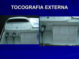 TOCOGRAFIA EXTERNA 