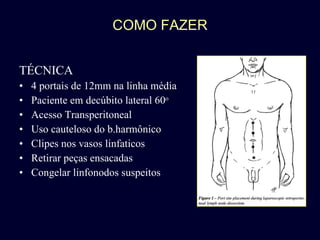 COMO FAZER TÉCNICA  4 portais de 12mm na linha média Paciente em decúbito lateral 60 o Acesso Transperitoneal Uso cauteloso do b.harmônico Clipes nos vasos linfaticos Retirar peças ensacadas Congelar linfonodos suspeitos 