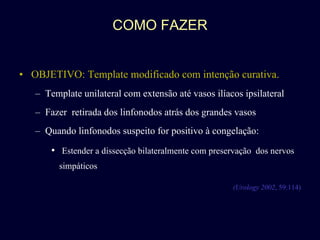 COMO FAZER OBJETIVO: Template modificado com intenção curativa. Template unilateral com extensão até vasos ilíacos ipsilateral Fazer  retirada dos linfonodos atrás dos grandes vasos Quando linfonodos suspeito for positivo à congelação: Estender a dissecção bilateralmente com preservação  dos nervos simpáticos (Urology 2002 , 59:114) 