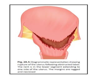 Management of hemorrhegic shock
contd…
• Management of uterine inversion.
– Replacement of the uterus needs to be
undertak...