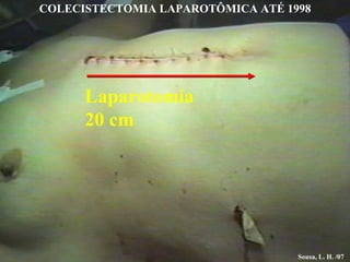 Laparotomia 20 cm Sousa, L. H. /07 COLECISTECTOMIA LAPAROTÔMICA ATÉ 1998 