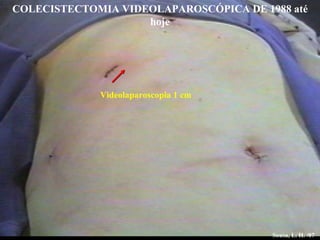 Videolaparoscopia 1 cm Sousa, L. H. /07 COLECISTECTOMIA VIDEOLAPAROSCÓPICA DE 1988 até hoje 