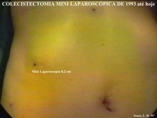 Mini Laparoscopia 0,2 cm Sousa, L. H. /07 COLECISTECTOMIA MINI LAPAROSCÓPICA DE 1993 até hoje 