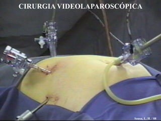 CIRURGIA VIDEOLAPAROSCÓPICA I O Sousa, L. H. / 08 
