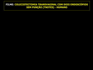 FILME:  COLECISTECTOMIA TRANSVAGINAL COM DOIS ENDOSCÓPIOS SEM PUNÇÃO (TNOTES) - HUMANO 