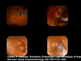 Sousa, L. H. / 99 Cotton, P, Kozarekr, Scahapiro. Endoscopic Laser lithotripsy of large bile duct  stone. Gastroenterology. 99:1128-1133, 1940. Sousa, L. H. / 08 