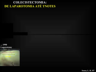 ... 1990 Laparotomy Sousa, L. H. /07 20 cm COLECISTECTOMIA: DE LAPAROTOMIA ATÉ TNOTES 