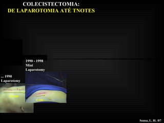 COLECISTECTOMIA: DE LAPAROTOMIA ATÉ TNOTES 1990 - 1998 Mini Laparotomy Sousa, L. H. /07 ... 1990 Laparotomy 20 cm 4 cm 