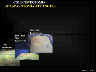1998 - 2007 Laparoscopy Sousa, L. H. /07 1990 - 1998 Mini Laparotomy ... 1990 Laparotomy 20 cm 4 cm 1 cm COLECISTECTOMIA: DE LAPAROTOMIA ATÉ TNOTES 
