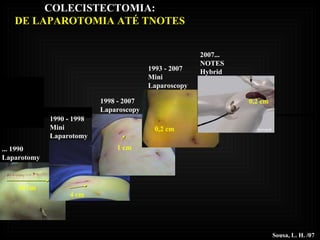 2007... NOTES Hybrid Sousa, L. H. /07 1993 - 2007 Mini Laparoscopy 1998 - 2007 Laparoscopy 1990 - 1998 Mini Laparotomy ... 1990 Laparotomy 20 cm 1 cm 4 cm 0,2 cm 0,2 cm COLECISTECTOMIA: DE LAPAROTOMIA ATÉ TNOTES 