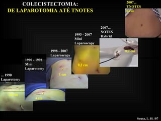 2007... NOTES Hybrid Sousa, L. H. /07 1993 - 2007 Mini Laparoscopy 1998 - 2007 Laparoscopy 1990 - 1998 Mini Laparotomy ... 1990 Laparotomy 20 cm 1 cm 4 cm 0,2 cm 0,2 cm 2007... TNOTES 0 cm COLECISTECTOMIA: DE LAPAROTOMIA ATÉ TNOTES 