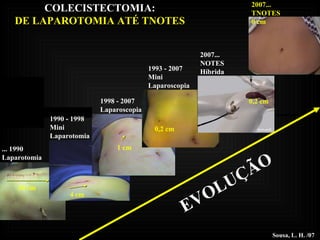 2007... NOTES Híbrida Sousa, L. H. /07 1993 - 2007 Mini Laparoscopia 1998 - 2007 Laparoscopia 1990 - 1998 Mini Laparotomia ... 1990 Laparotomia 20 cm 1 cm 4 cm 0,2 cm 0,2 cm 2007... TNOTES 0 cm EVOLUÇÃO COLECISTECTOMIA: DE LAPAROTOMIA ATÉ TNOTES 