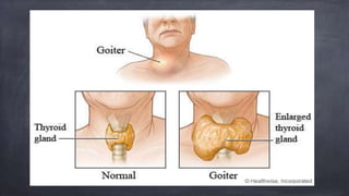 goiter.pptx