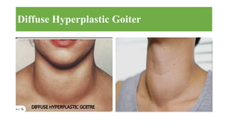 Comprehensive Overview of Goiter: Anatomy, Physiology, Diagnosis, and ...