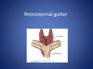 Retrosternal goiter
 