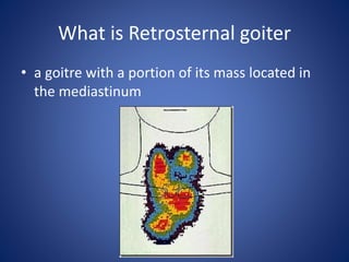 What is Retrosternal goiter
• a goitre with a portion of its mass located in
the mediastinum
 