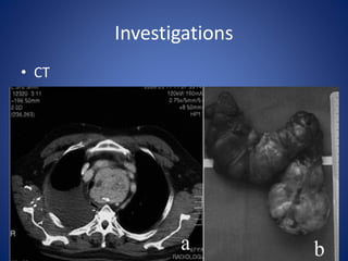 Investigations
• CT
 
