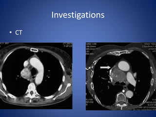 Investigations
• CT
 