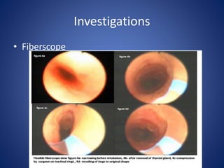 Investigations
• Fiberscope
 