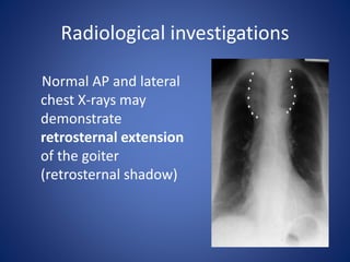Radiological investigations
Normal AP and lateral
chest X-rays may
demonstrate
retrosternal extension
of the goiter
(retrosternal shadow)
 