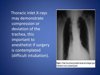 Thoracic inlet X-rays
may demonstrate
compression or
deviation of the
trachea, this
important to
anesthetist if surgery
is contemplated
(difficult intubation).
 