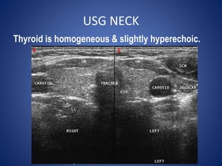 USG NECK
Thyroid is homogeneous & slightly hyperechoic.
 