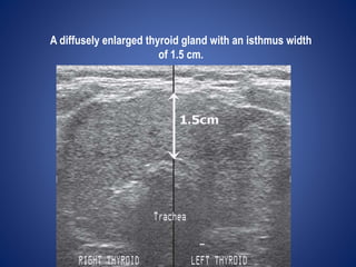 A diffusely enlarged thyroid gland with an isthmus width
of 1.5 cm.
 
