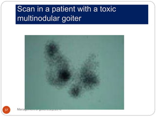 Scan in a patient with a toxic
multinodular goiter
Management of goiters,sep.2010
37
 