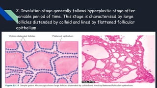 Comprehensive Overview of Goitre: Pathogenesis, Types, and Pathology | PPTX