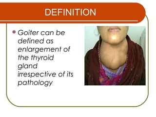 DEFINITION
Goiter can be
defined as
enlargement of
the thyroid
gland
irrespective of its
pathology
 