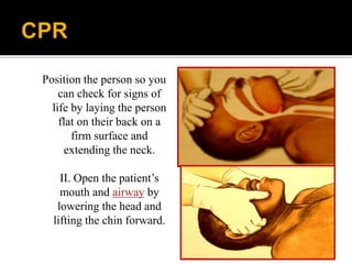 Position the person so you
can check for signs of
life by laying the person
flat on their back on a
firm surface and
extending the neck.
II. Open the patient’s
mouth and airway by
lowering the head and
lifting the chin forward.
 