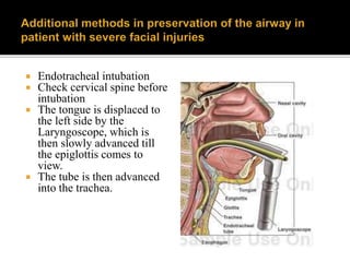  Endotracheal intubation
 Check cervical spine before
intubation
 The tongue is displaced to
the left side by the
Laryngoscope, which is
then slowly advanced till
the epiglottis comes to
view.
 The tube is then advanced
into the trachea.
 