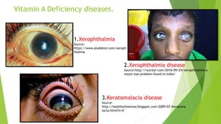 Vitamin A Deficiency diseases.
1.Xerophthalmia
Source-
https://www.alodokter.com/xeroph
thalmia
3.Keratomalacia disease
Source-
http://healthonlinenow.blogspot.com/2009/07/keratoma
lacia.html?m=0
2.Xerophthalmia disease
Source-http://nutrilyf.com/2016/09/24/xerophthalmia-a-
major-eye-problem-found-in-india/
 