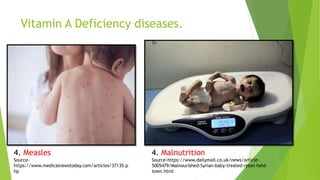 Vitamin A Deficiency diseases.
4. Measles
Source-
https://www.medicalnewstoday.com/articles/37135.p
hp
4. Malnutrition
Source-https://www.dailymail.co.uk/news/article-
5005479/Malnourished-Syrian-baby-treated-rebel-held-
town.html
 