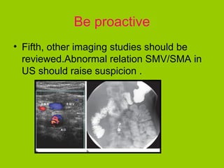 Be proactive
• Fifth, other imaging studies should be
  reviewed.Abnormal relation SMV/SMA in
  US should raise suspicion .
 