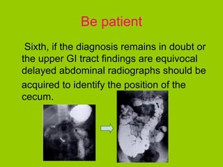 Be patient
 Sixth, if the diagnosis remains in doubt or
the upper GI tract findings are equivocal
delayed abdominal radiographs should be
acquired to identify the position of the
cecum.
 