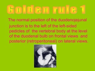 The normal position of the duodenojejunal
junction is to the left of the left-sided
pedicles of the vertebral body at the level
of the duodenal bulb on frontal views and
posterior (retroperitoneal) on lateral views.
 