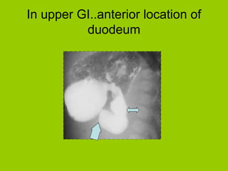 In upper GI..anterior location of
          duodeum
 