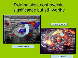 Swirling sign..controversial
significance but still worthy


                      Swirling SMV




  anticlockwise




                          clockwise
 