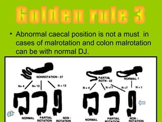 • Abnormal caecal position is not a must in
  cases of malrotation and colon malrotation
  can be with normal DJ.




!
 