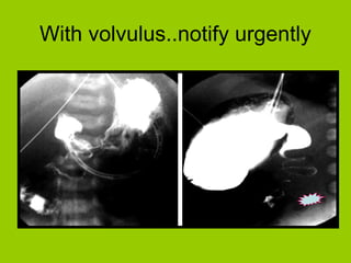 With volvulus..notify urgently
 