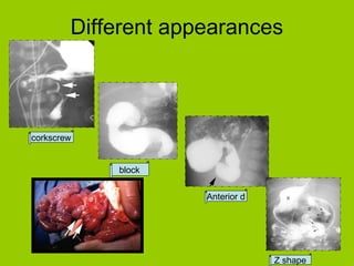 Different appearances



corkscrew


            block


                     Anterior d




                                  Z shape
 